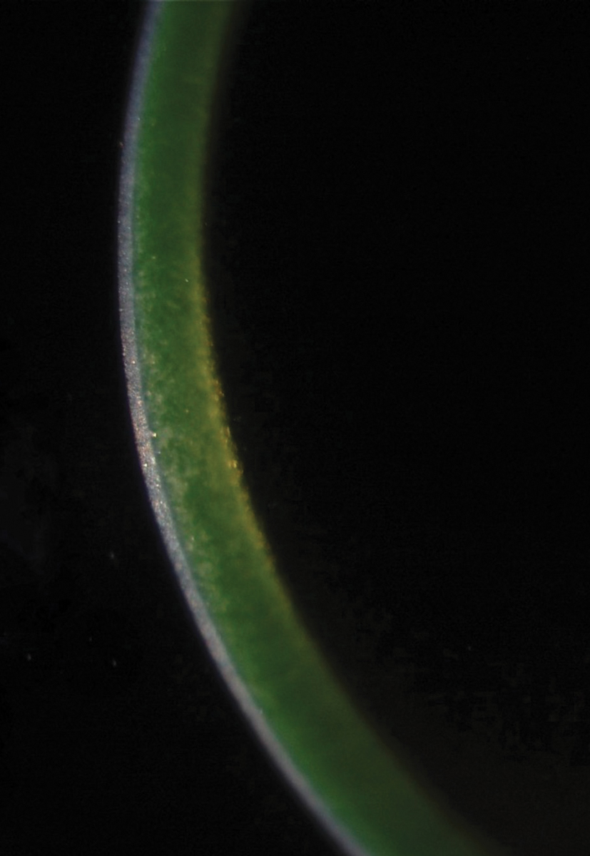 Fig. 2. The green glow of riboflavin indicates adequate penetration into the corneal stroma prior to CXL.