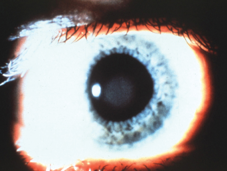 Fig. 4. Central corneal clouding caused by PMMA lens wear.