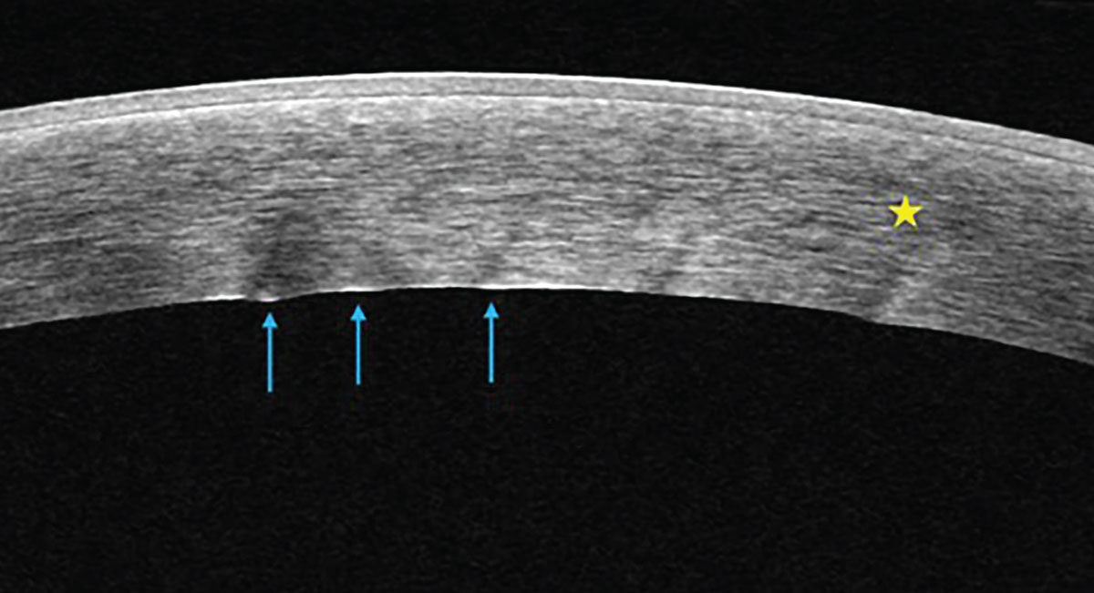 Anterior segment OCT of a cornea with microcystic stromal edema (yellow star) and endothelial folds (blue arrows) secondary to endothelial pump dysfunction from herpetic disease.