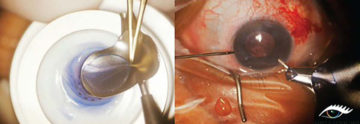 Left: A 9mm donor graft is loaded in preparation for DSEK procedure in patient with severe endothelial decompromise. Right: Donor tissue is folded up like a taco with endothelium side up in order to insert through a temporal incision.