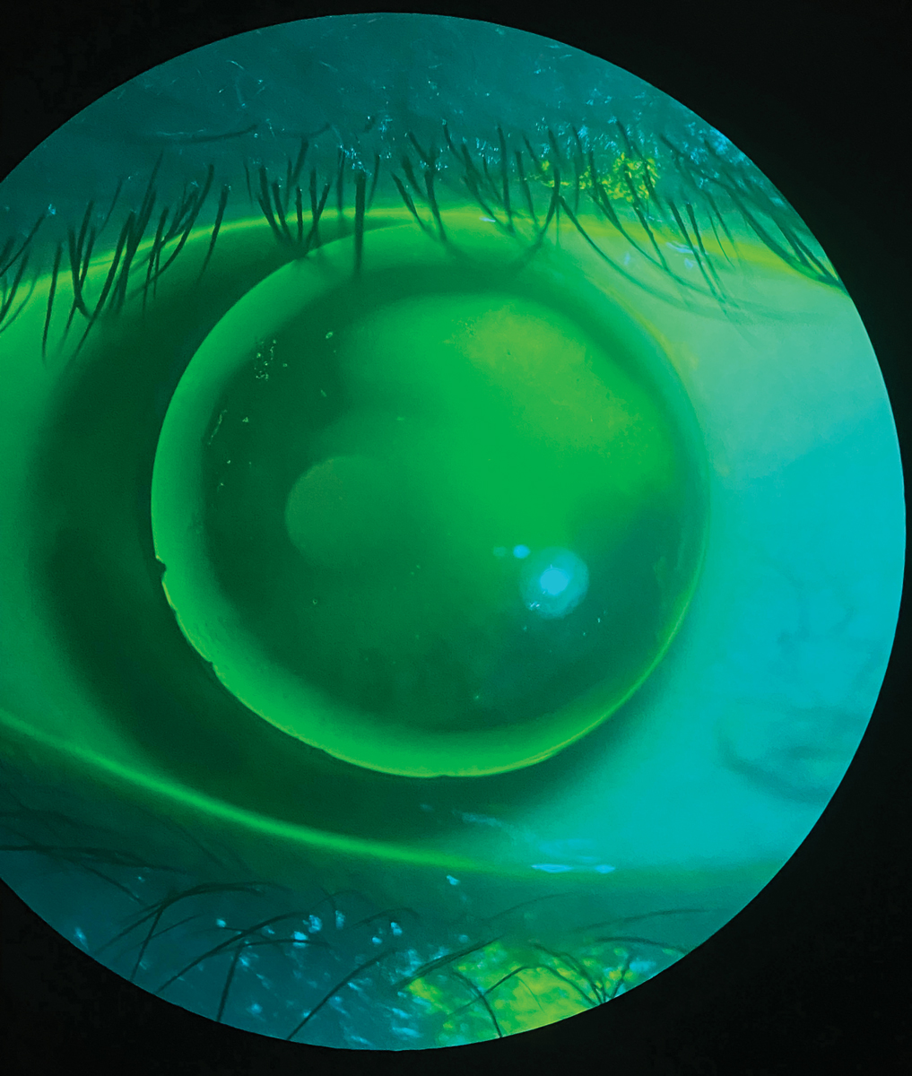 Fig. 1. A patient wearing a GP lens presenting with issues of severe discomfort and peripheral corneal staining from a chipped edge.