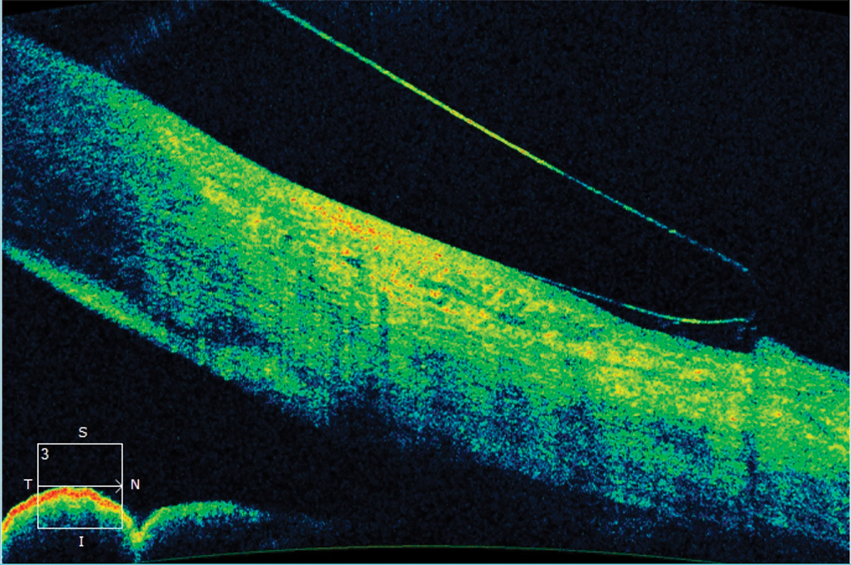 Fig. 3. Anterior segment OCT image showing edge lift of a scleral lens. This indicates a flat landing zone. A steeper landing zone was ordered to improve the haptic alignment.
