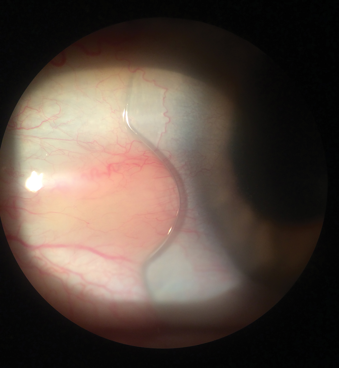 Fig. 4. Scleral lens with a notch to avoid interacting with a pinguecula.
