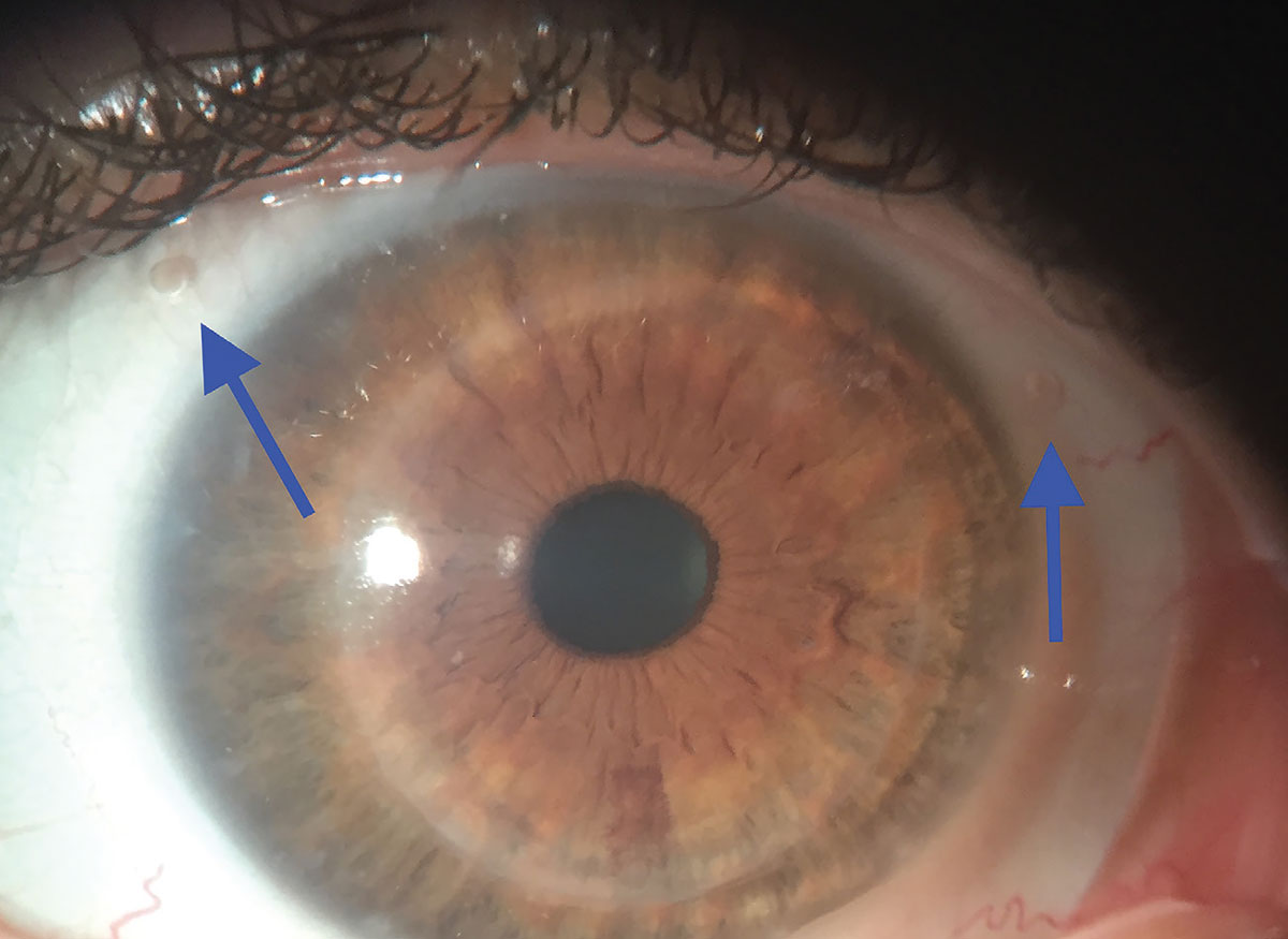 Fig. 2. Two fenestrations are included in the limbal area at two o’clock and ten o’clock.