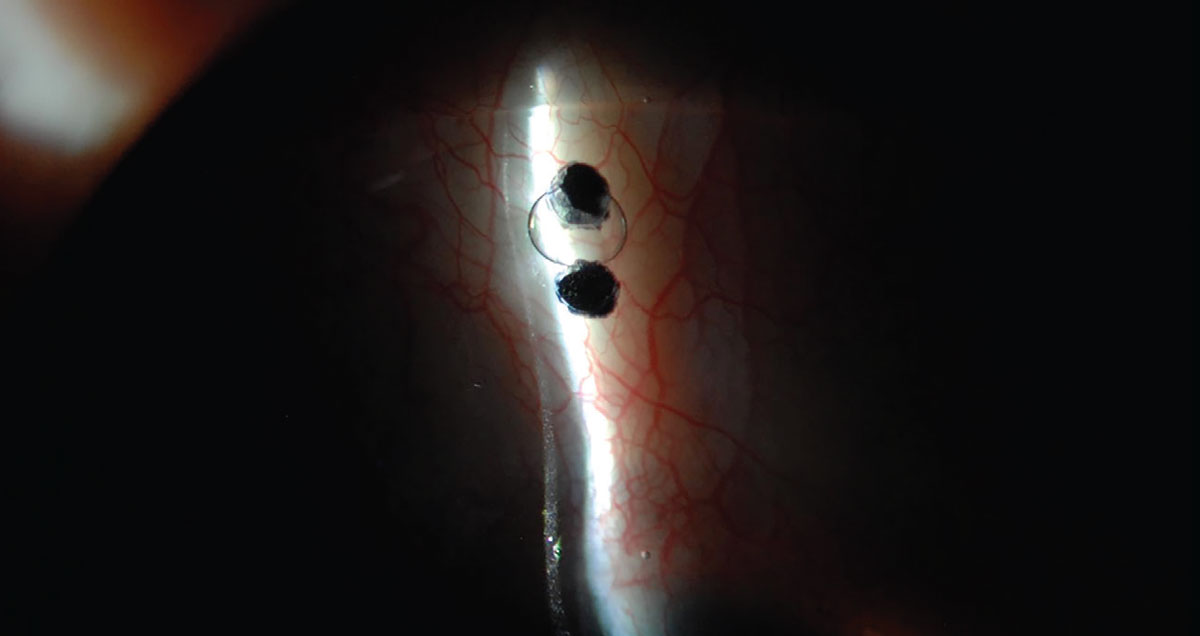 Fig. 4. A fenestration included in the scleral area of the lens.