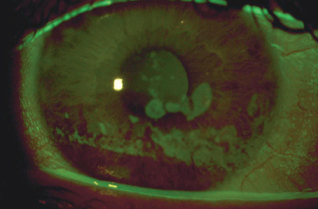 Coarse epithelial keratopathy: a common indication for scleral lens wear in OGVHD patients.