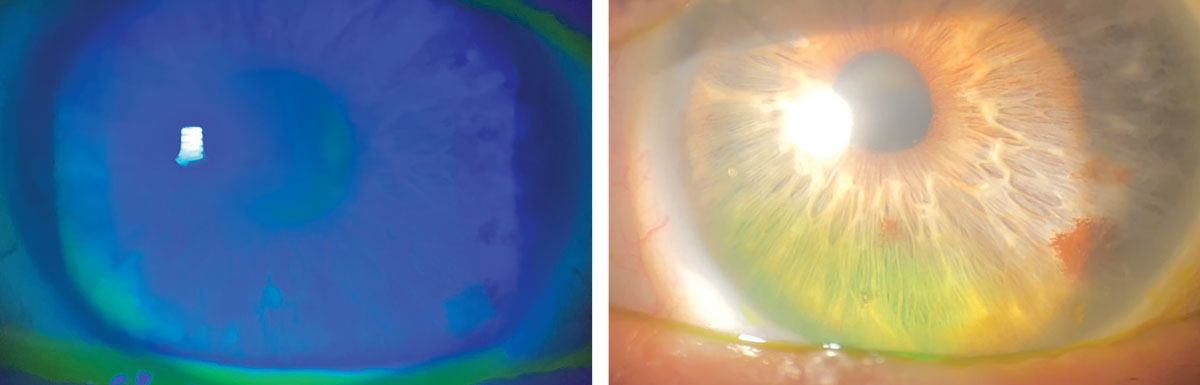 Significant improvement in coarse epithelial keratopathy following scleral lens wear for OGVHD.