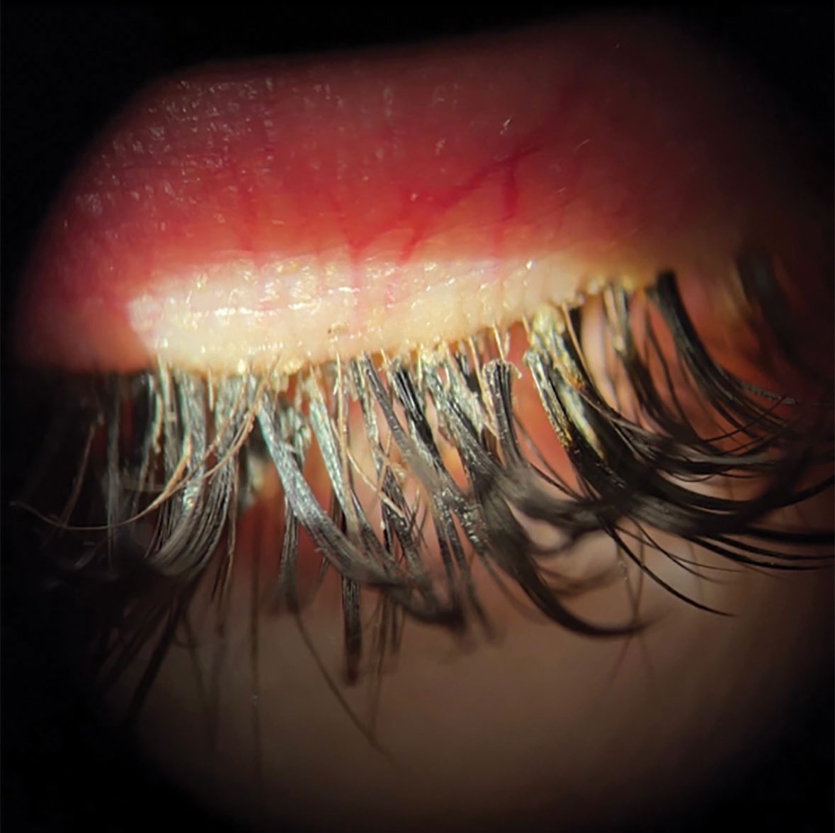 Patient with eyelash extensions and blepharitis.
