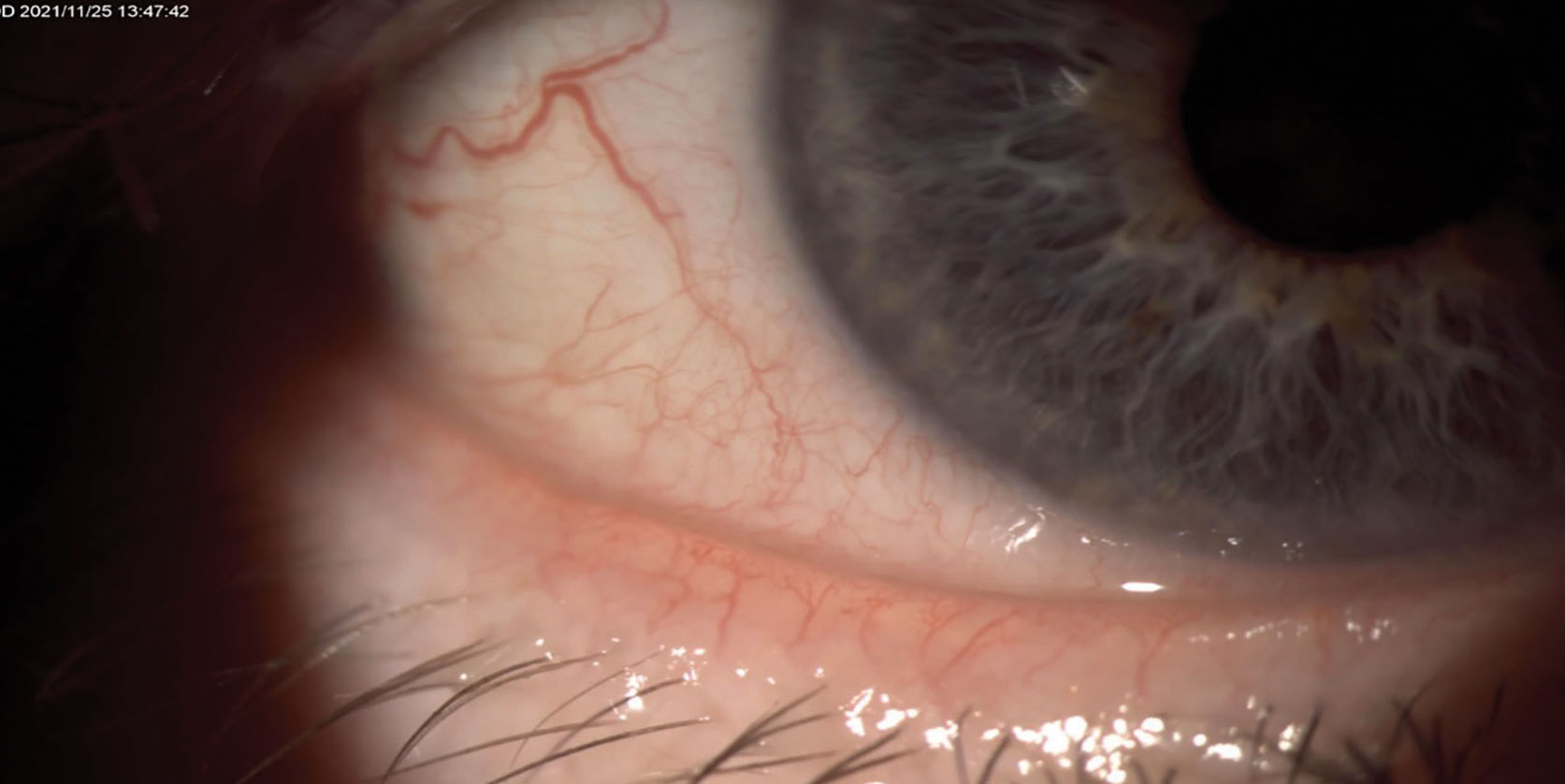 Patient with ocular rosacea and eye telangiectasia contributing to MGD.
