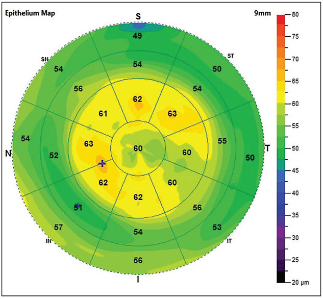 If a patient’s eye has both superior corneal epithelial thickness <45µm and Schirmer’s test result <10mm, they are five times more likely to have antibody-positive bloodwork and associated visual compromise.