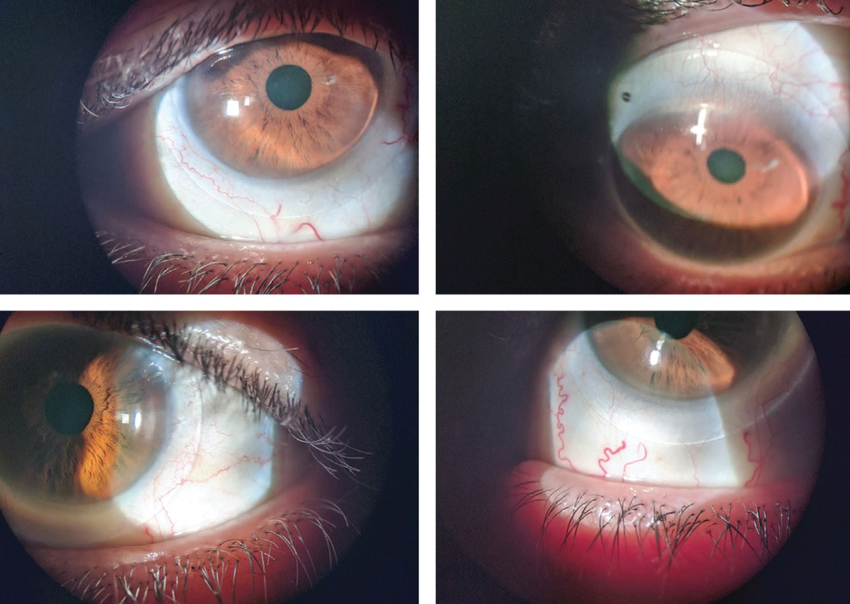 Scleral lenses fitted on a patient with post-refractive surgery ectasia. 