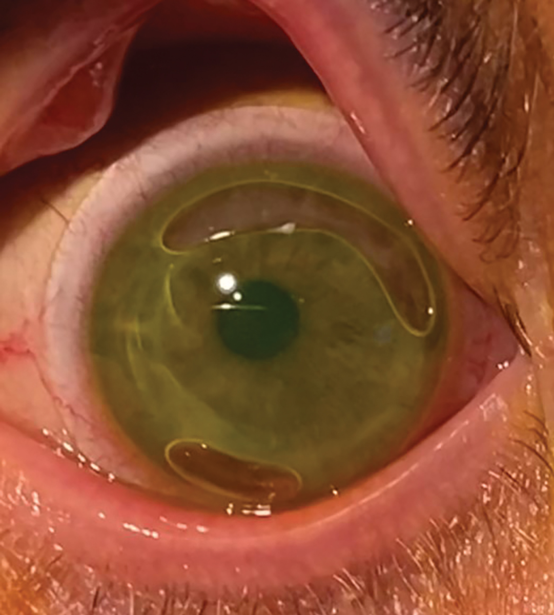 Scleral lens application can be a challenge for some patients, leading to bubbles and eye irritation if the patient isn’t aware of their presence. 
