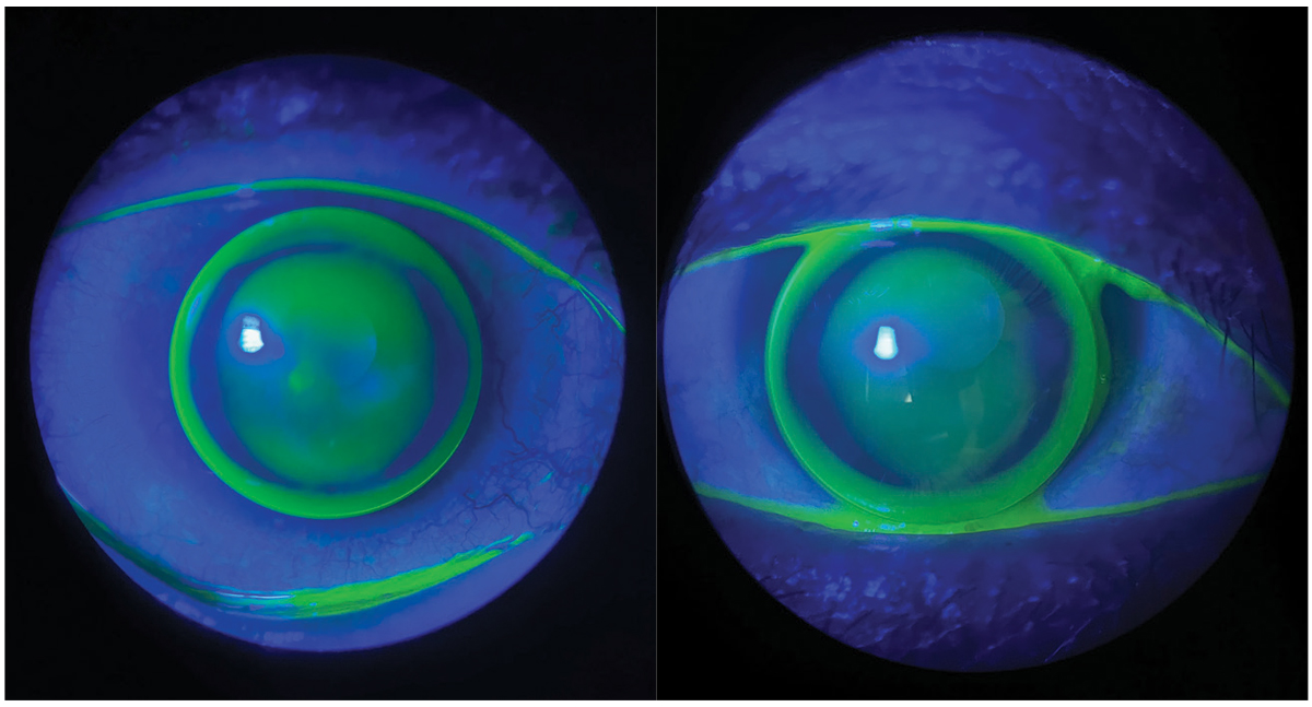 Scleral lens for a keratoconus patient with corneal Intacs.