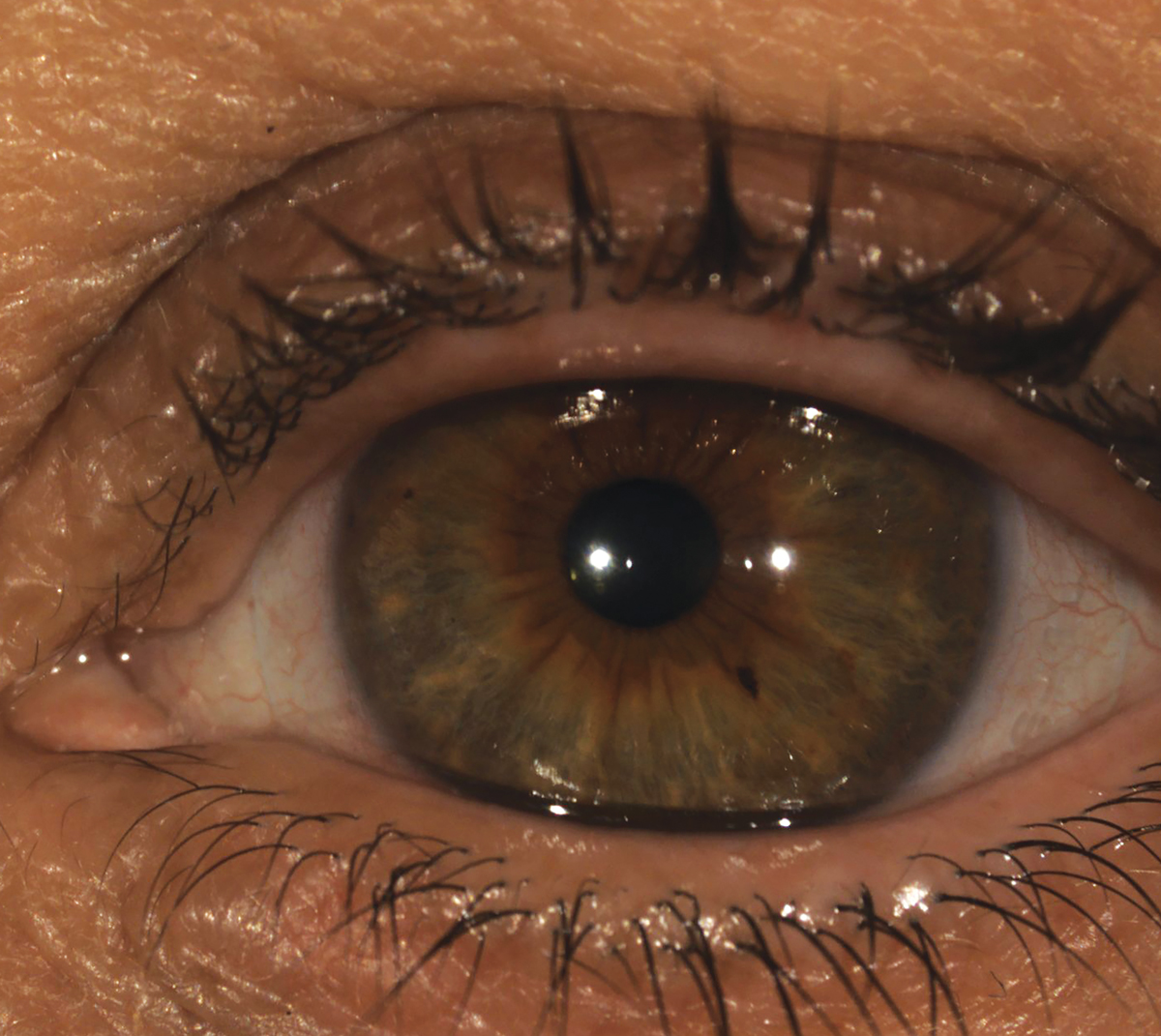 A patient wearing a custom scleral lens called the Latitude (Visionary Optics). 