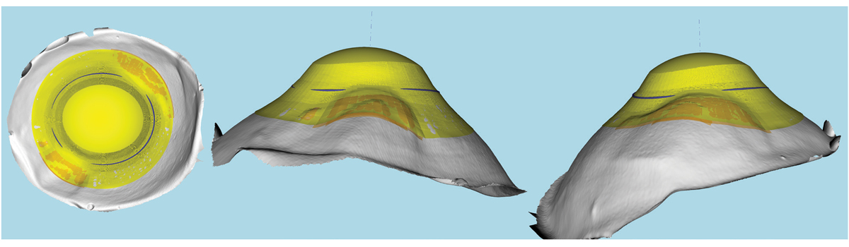 This is a 3D representation of an elevation-specific freeform impression-based EyePrint lens.