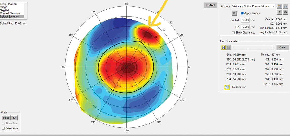 Using scleral profilometry can help clinicians create a well-designed lens that works best for the patient. 
