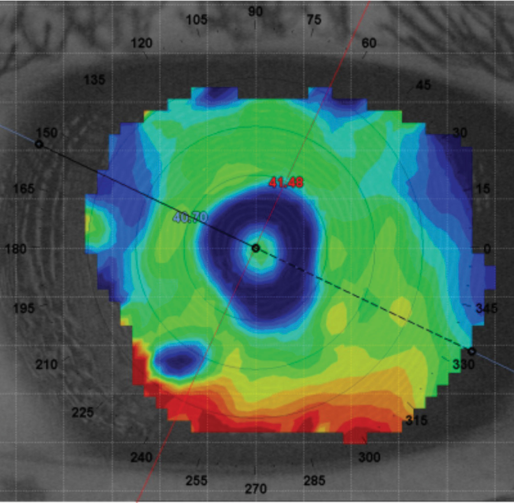 Over-lens topography of the left eye showing appropriate alignment with multifocal optics with the line of sight. Tangential map scaled to accentuate the multifocal.