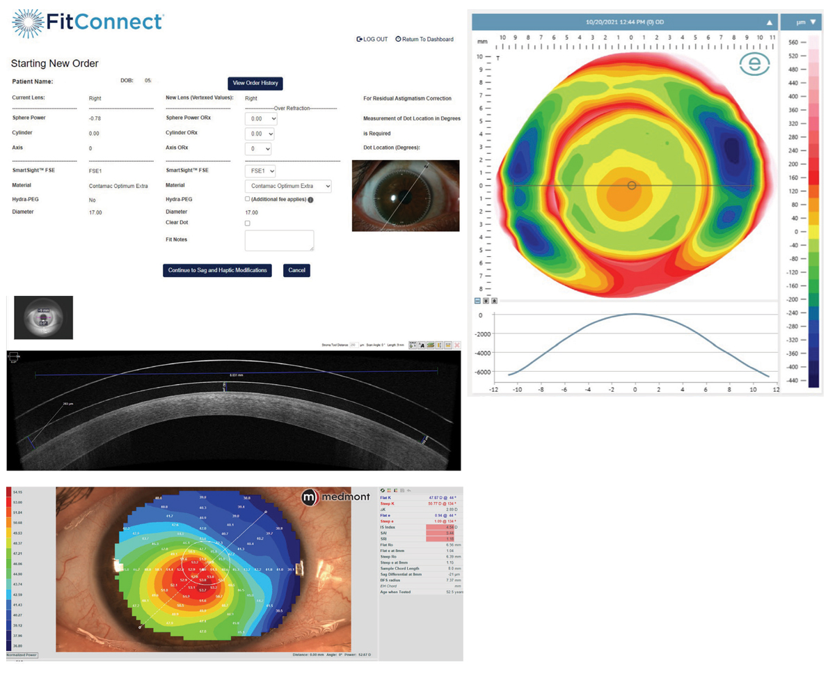 Case 2. Medmont topography and ESP prolifometry of a keratoconus patient with an unstable cornea. A BostonSight Smart 360 digital lens was designed. AS-OCT raster scan of cornea and BostonSight scleral lens were taken 10 to 14 days later.