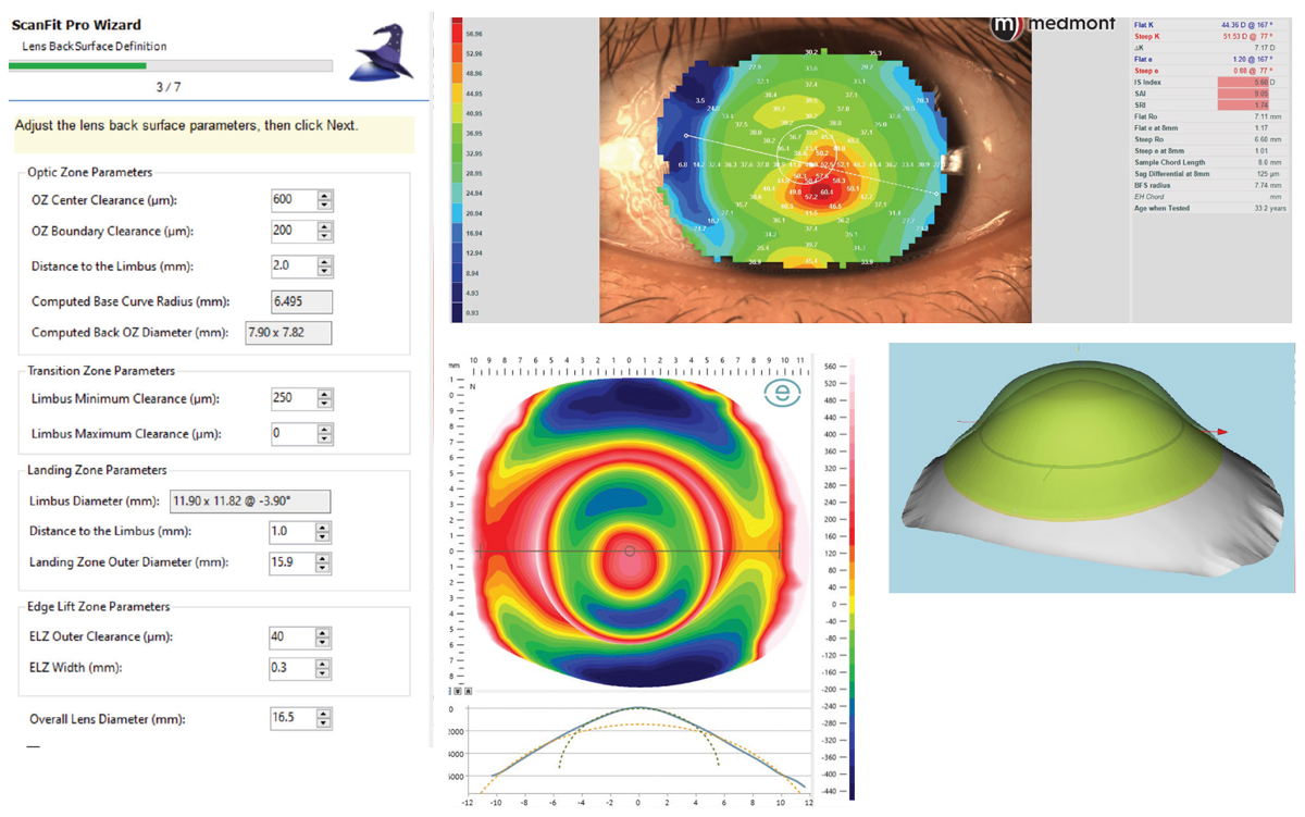 Case 3. Medmont topography and ESP profilometry of a patient with a highly toric cornea and sclera, as well as a steep cone. A ScanFit Pro digital lens was designed. The ScanFit Pro screen for back surface parameters is shown, as well as the final result.