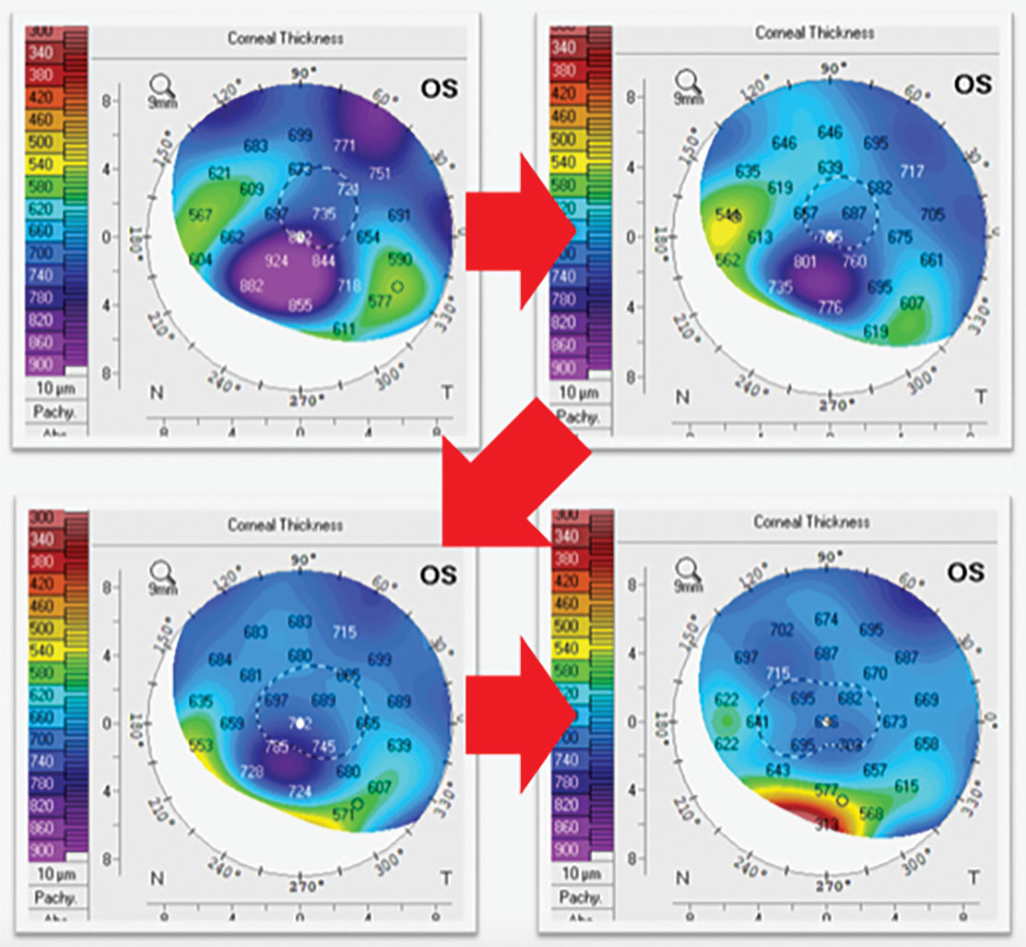 Fig. 2. Corneal pachymetry maps of a patient with corneal edema who was started on topical  rho-kinase inhibitor showing gradual improvement on edema.