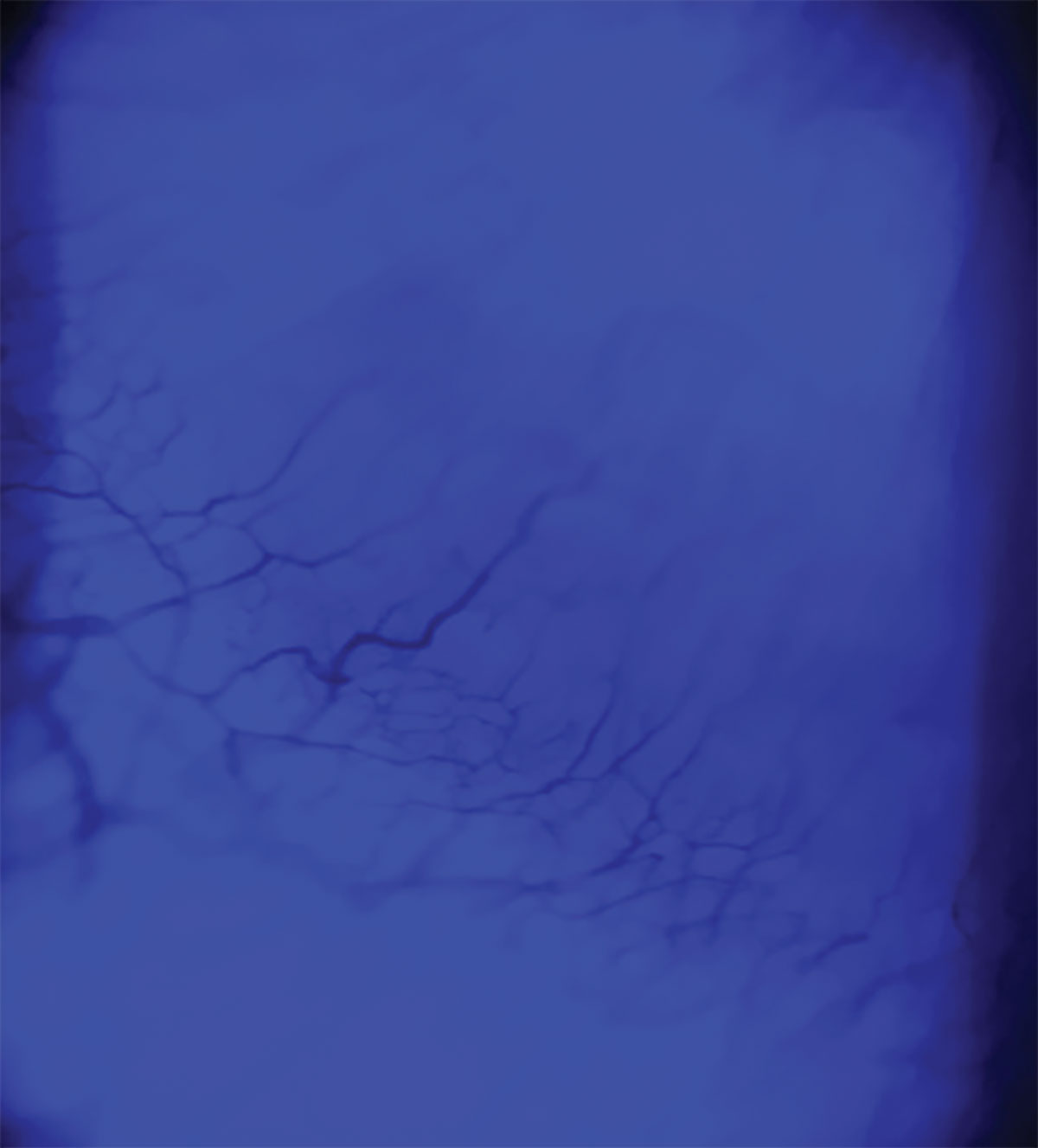 Fig. 3. Corneal neovascularization resulting from scleral lens extended wear visualized with cobalt light filter.