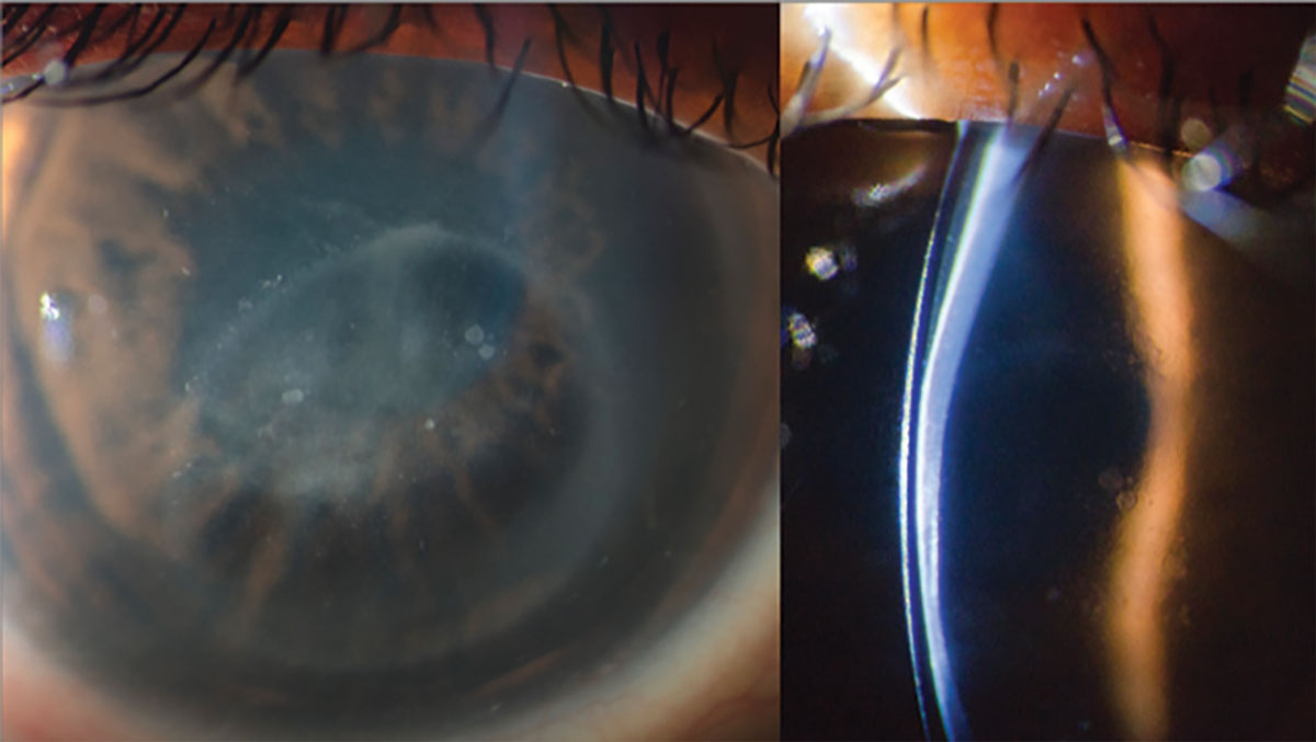 Fig. 5. Slit beam illumination demonstrating contact of a scleral lens with cornea (left). Direct visualization of scleral lens bearing on central cornea (right).