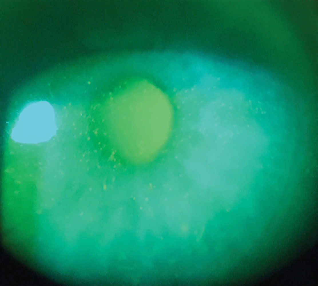 Fig. 6. Punctate epithelial erosions from a patient wearing a scleral lens filled with multipurpose soft contact lens solution.