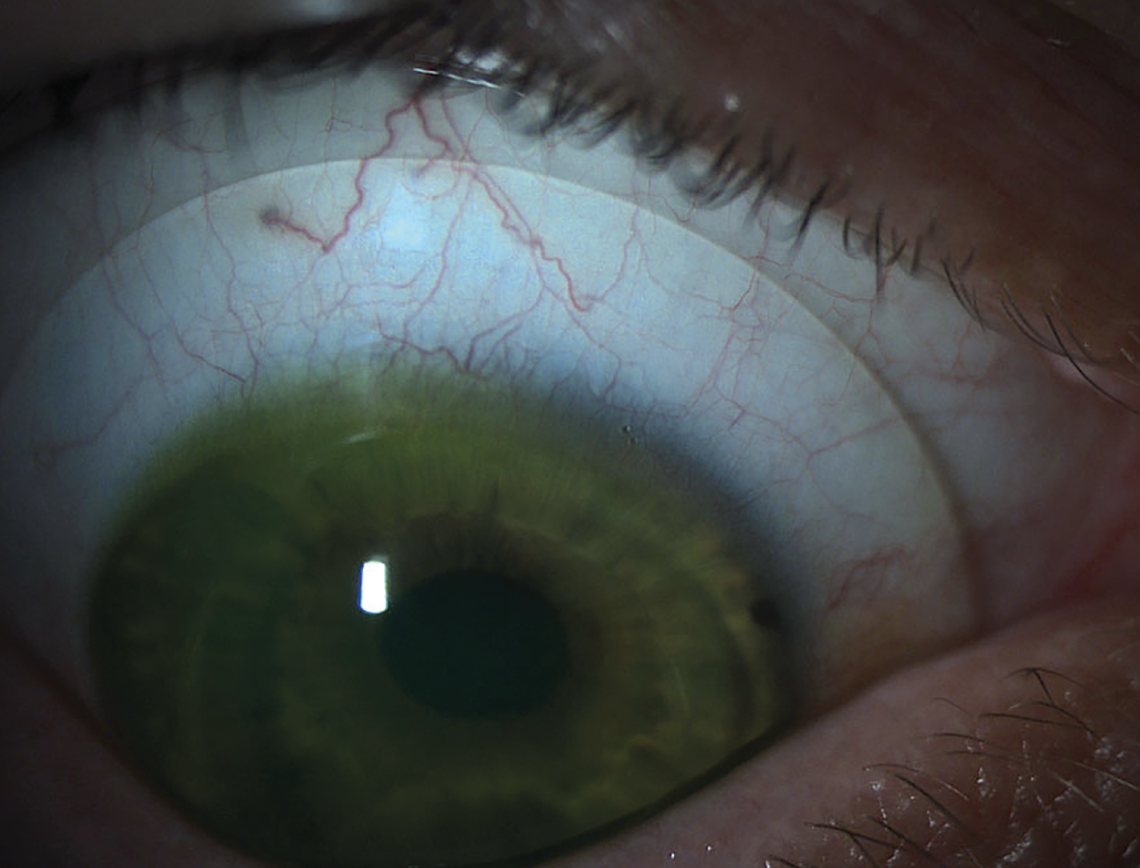 Fig. 1. Scleral lenses are often the best choice to fit irregular corneas.