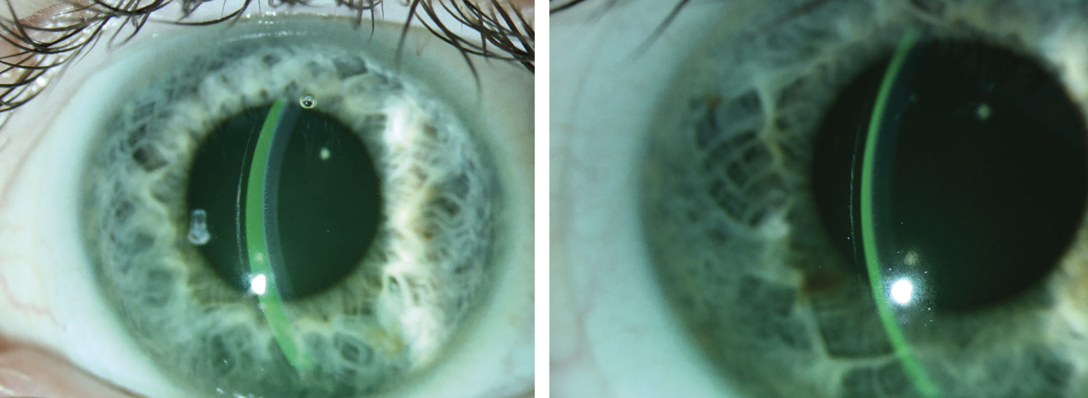 Fig. 2. (Left) A lens with proper clearance. (Right) A different lens showing excessive clearance, which could lead to decreased vision, post-lens debris and conjunctival impingement. 