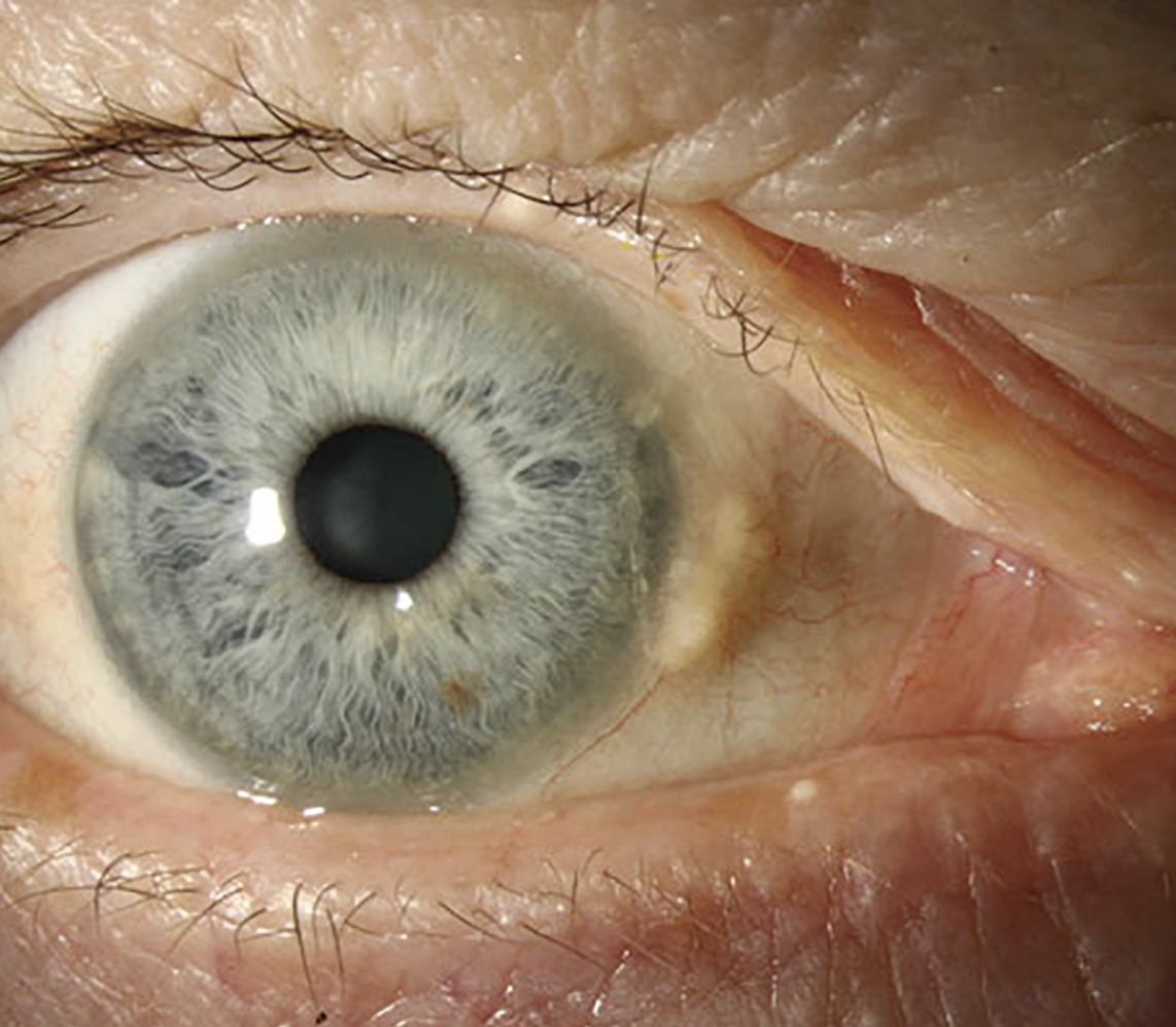 Fig. 6. To accommodate a scleral or conjunctival elevation due to abnormalities such as pinguecula, clinicians have several options, such as adjusting the diameter, adding a focal area of vault or notching the lens edge.