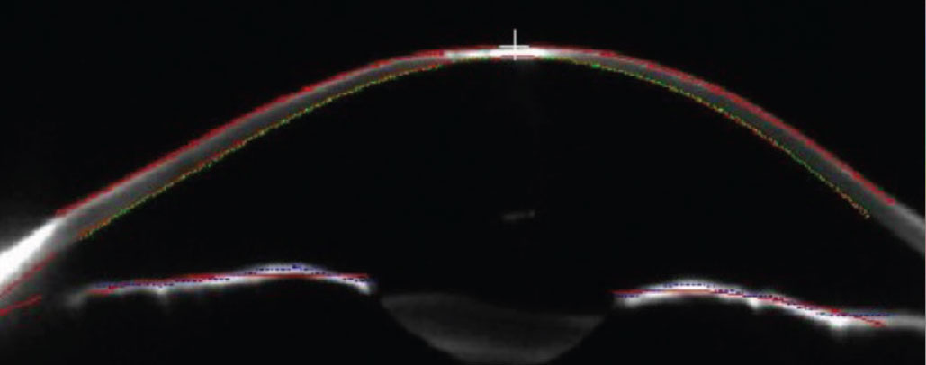 Schiempflug cross-sectional image of the left cornea. Note the central corneal scar.