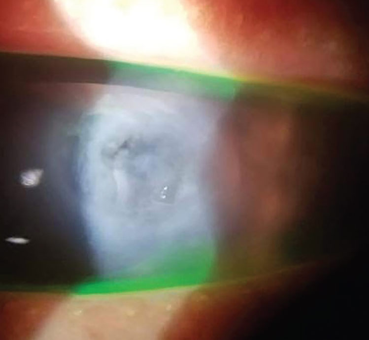 A case of an acute corneal hydrops.