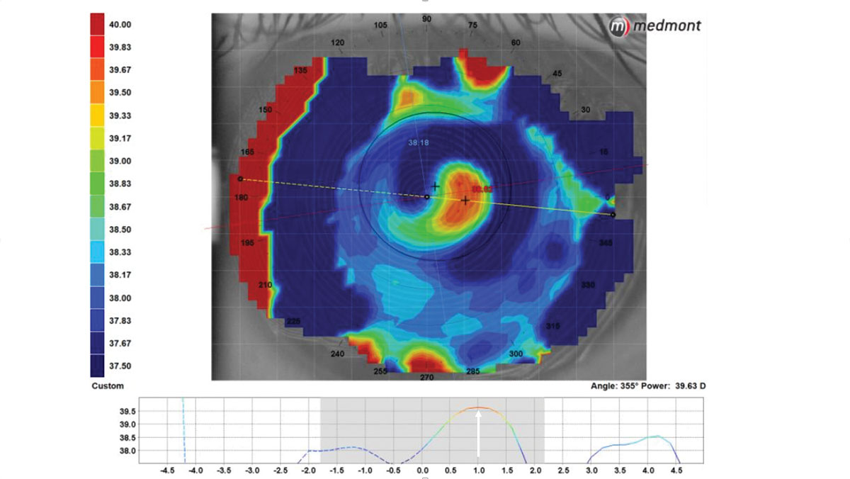 Fig. 2. The condensed topography scale shows a 2.5mm center-near scleral multifocal optical zone that is 1mm decentered temporally on the eye.