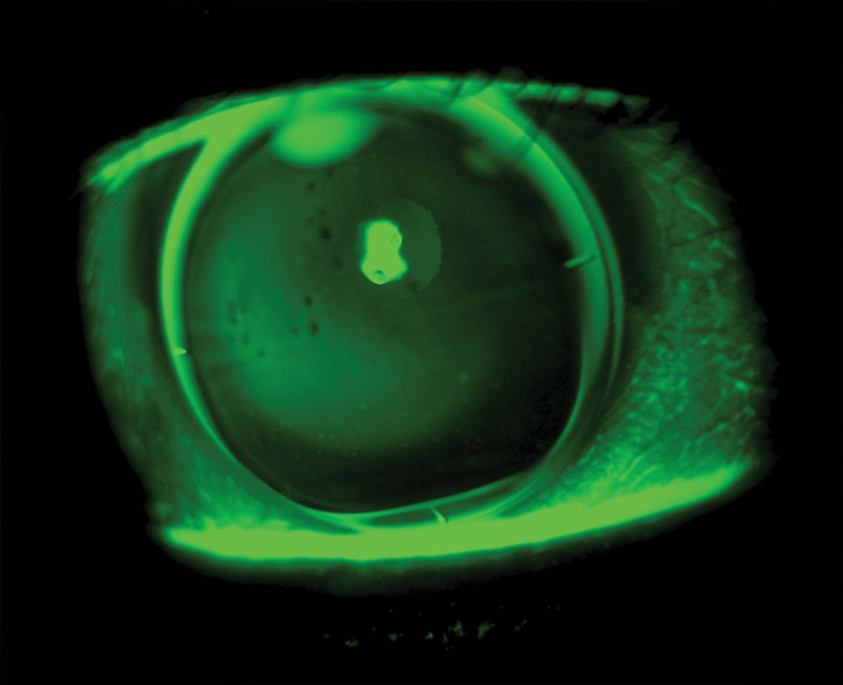 Fig. 4. Translating progressive GP lens. Note the seg lines below the inferior pupil margin indicating the seg height will likely need to be raised for improved near vision.