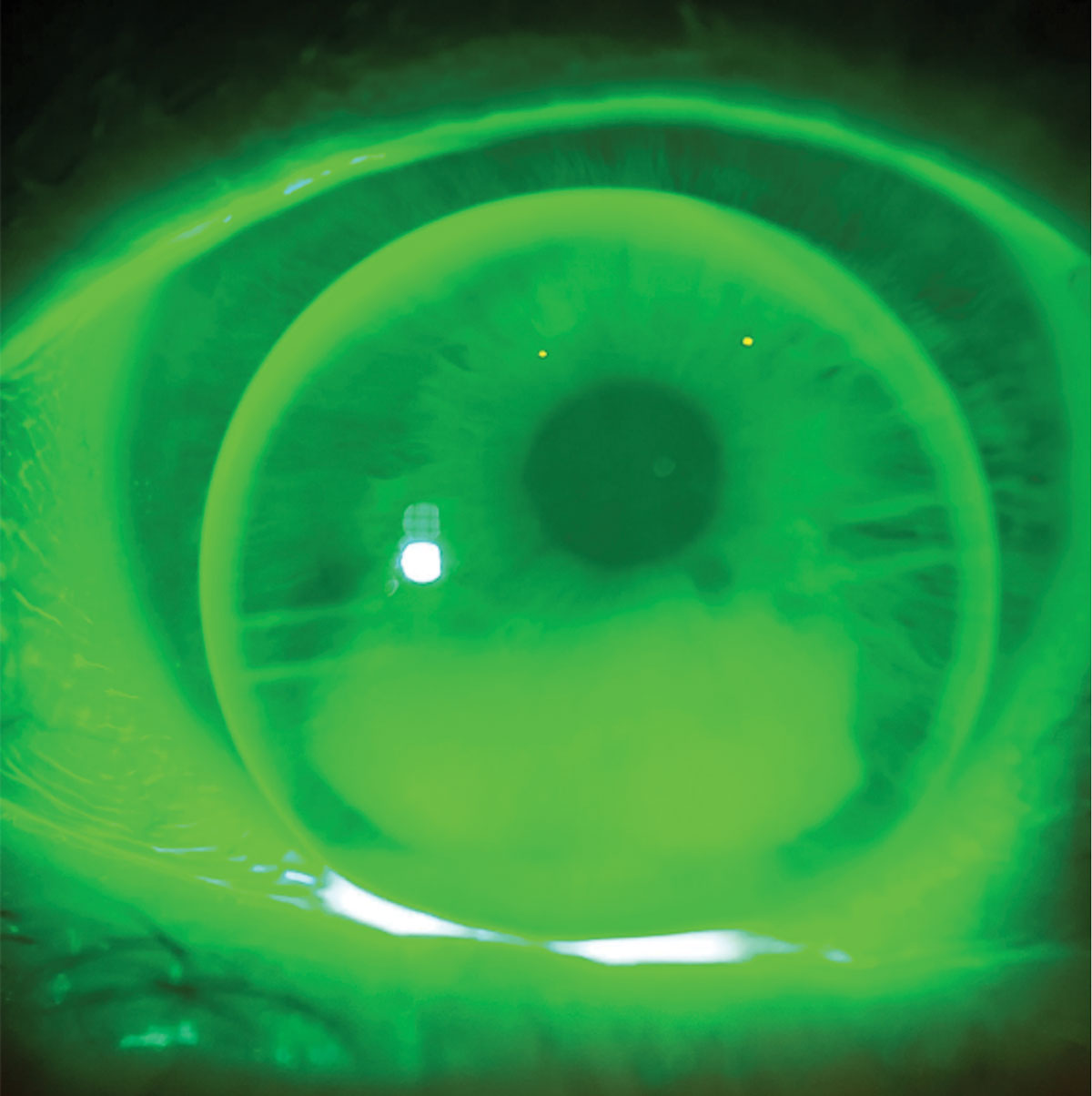 Fig. 5. Seg height was brought down 0.2mm to improve the patient’s vision at distance while still allowing easy access to the intermediate and near zones in the translating trifocal optic.