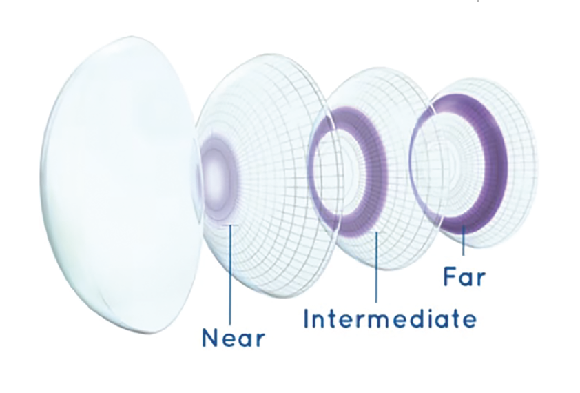 Fig. 1. Alcon’s “precision profile design” (in Dailies Total1, Dailies AquaComfort Plus and Air Optix plus HydraGlyde multifocal lenses) provides additional minus power at the optic zone edge to optimize near vision without compromising distance acuity. 