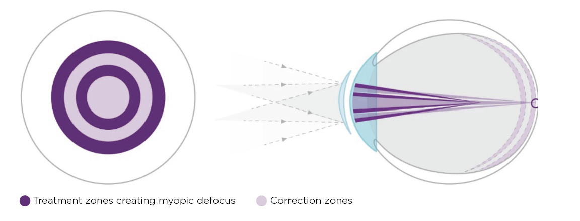 Fig. 7. The MiSight 1 Day lens uses what the company calls “ActivControl technology,” consisting of two discrete rings with a +2.00D add (dark purple) to create myopic defocus on the retina.