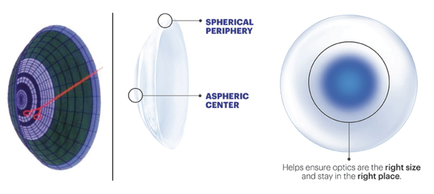Fig. 8. The original Acuvue bifocal CL (left) had five concentric rings to reduce glare in low lighting. The present design (right) is aspheric within the center but spherical in the periphery and the optic zone varies by the patient’s refractive power and age.