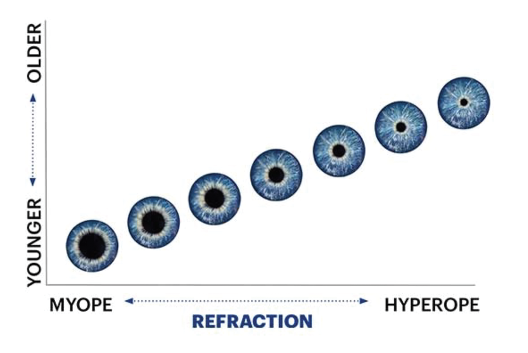 Fig 9. J&J’s multifocal design adjusts pupil size not only by age (increasing add power) but also by refractive error. 