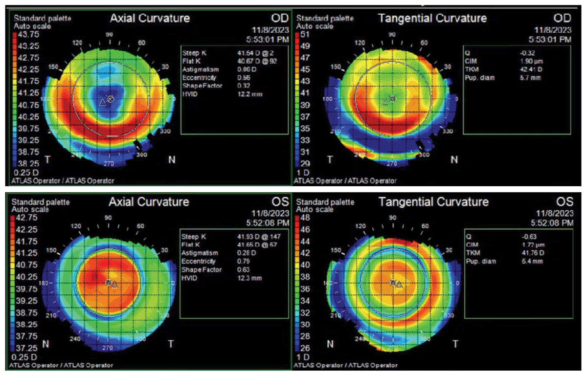 Topography (Humphrey Atlas) maps of new ortho-K lens result showing central steepening OS (the near eye), which corresponds to improved near acuity in that eye.