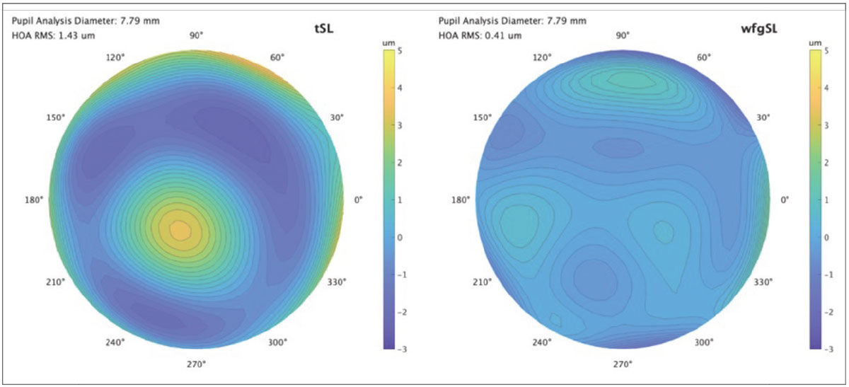Fig. 3. Comparison of wavefront maps of the patient from Fig. 2. wearing the tSL vs. wfgSL.