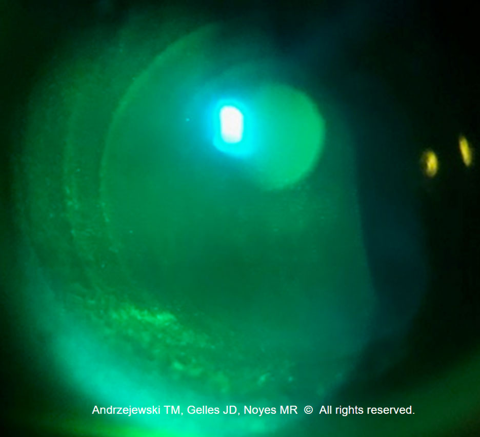 Midperipheral corneal staining, indicated by the seal-off around the GP edge of the hybrid.