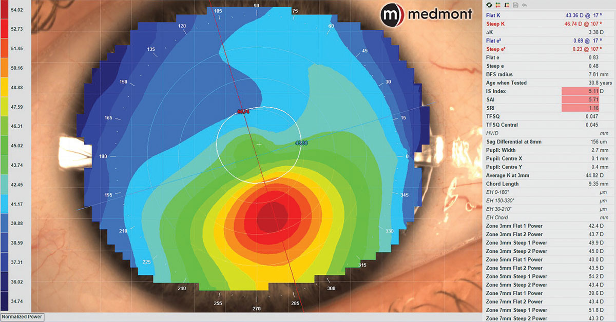 Fig. 4. Axial corneal topography map of keratoconus demonstrating normal Sim K values of the central corneal zone but irregular curvature inferiorly with abnormal symmetry analytics.