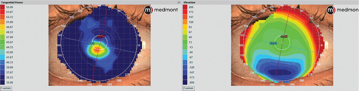 Fig. 5. Placido disc corneal topography of keratoconus showing marked color scale differences and patterns between tangential dioptric power (left) and elevation (right) maps, demonstrating how the same ocular surface will have very different map appearances between curvature and elevation data. 
