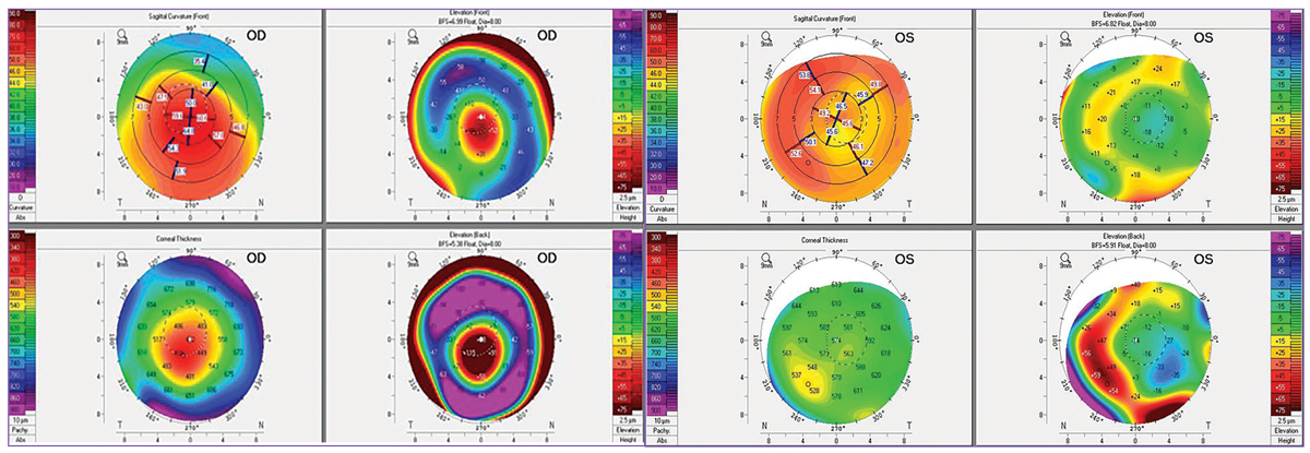 Pentacam maps of patient in Case #3 showing keratoconus OD and a corneal transplant OS.
