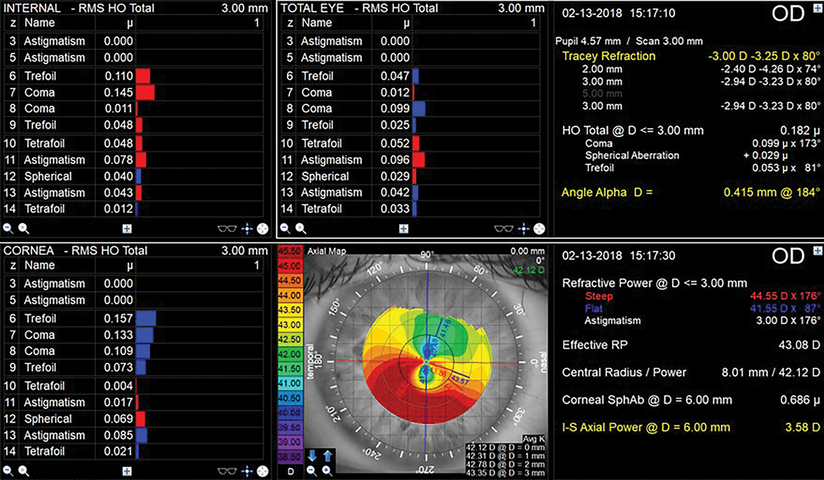 Topography and aberrometry readings from the right eye of the patient in Case #4.
