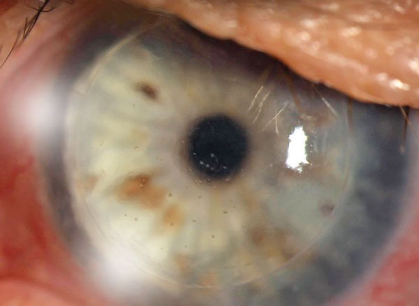 Tackling Corneal Transplants  in Clinical Practice